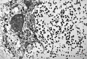 F, 24y. | molluscum contagiosum